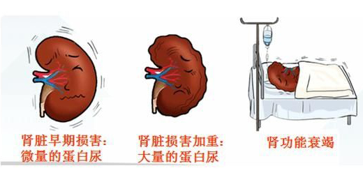 肾炎危害.jpeg