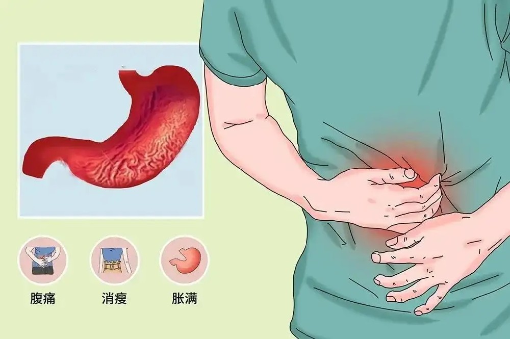 慢性萎缩性胃炎.jpg