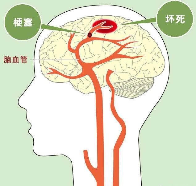 脑梗塞01.jpg