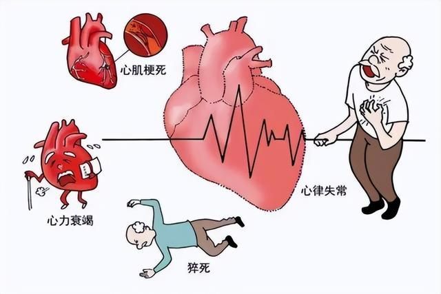 心肌梗 死01.jpeg