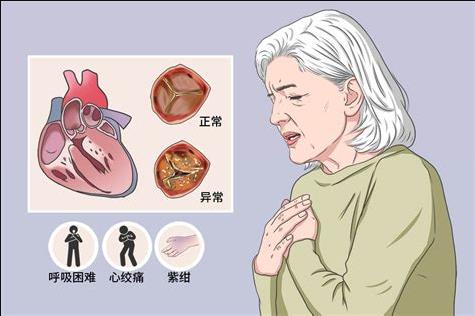 心绞痛02.jpg