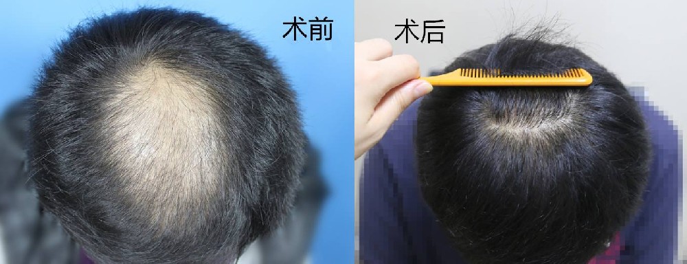 脱发植发手术.jpg