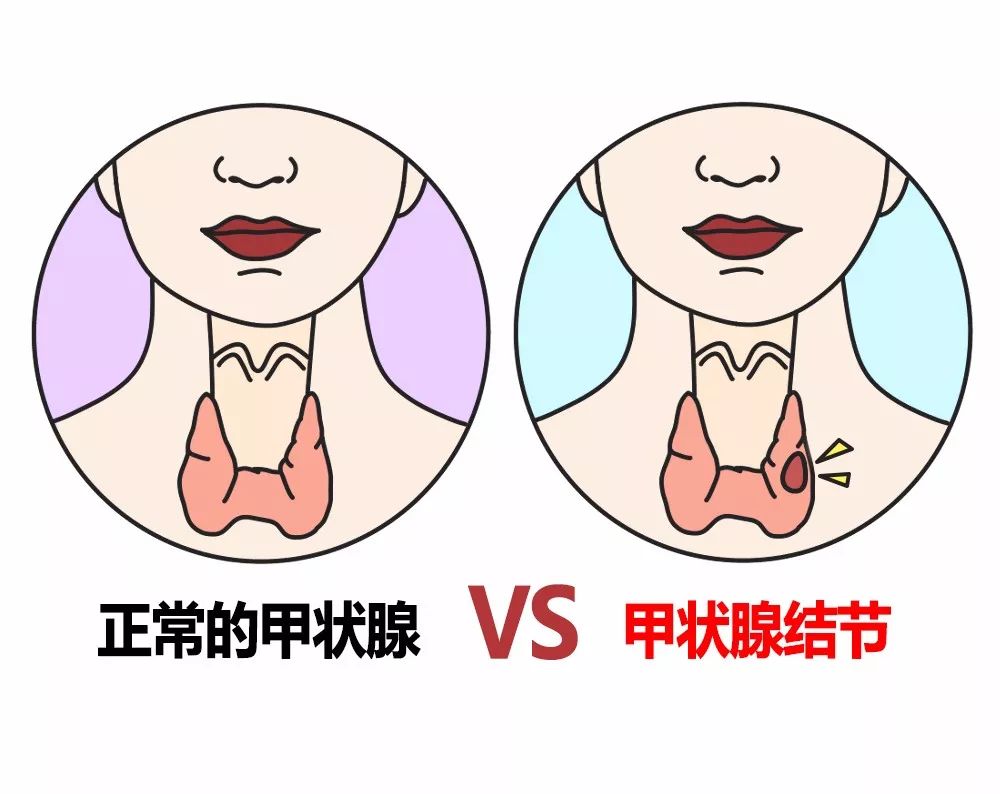 甲状腺结节01.jpeg