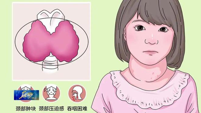 甲状腺肿.jpg