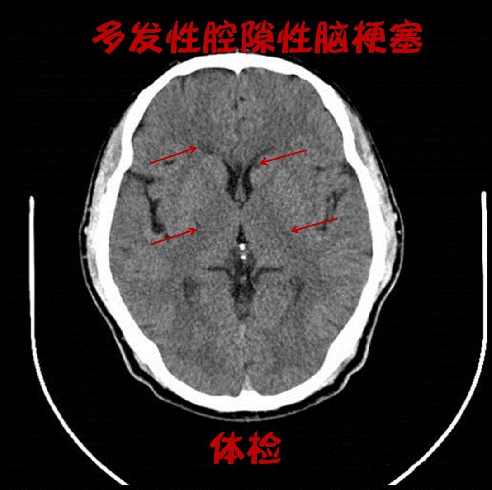腔梗_副本.jpg